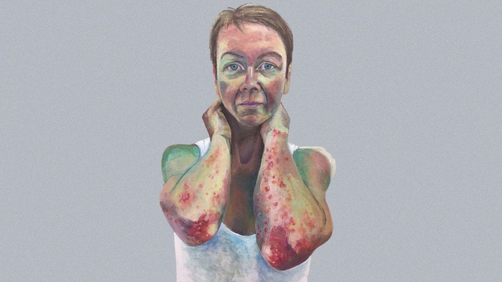 A painting of a woman with psoriasis and eczema on her elbows, a concept of skin disease.